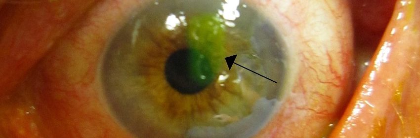 Human cornea with abrasion